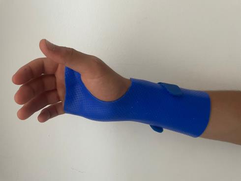Tutori/splint su misura per arto superiore