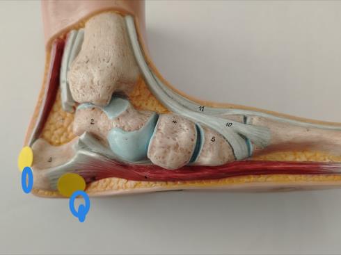 Sperone Calcaneare